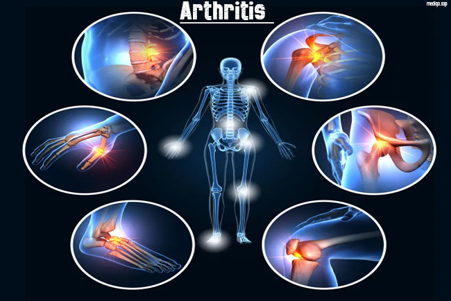 arthritis