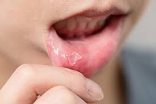 canker sore treatment