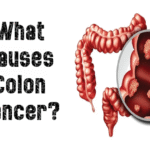 what causes colon cancer