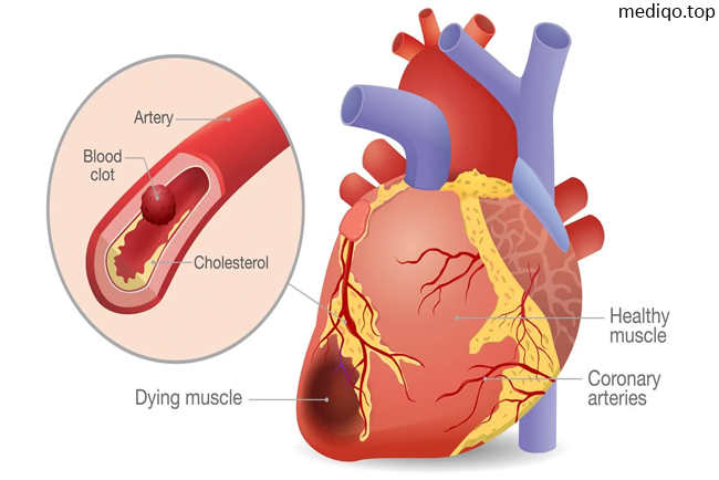 Am I Having a Heart Attack? A Woman's Guide to Recognizing the Signs