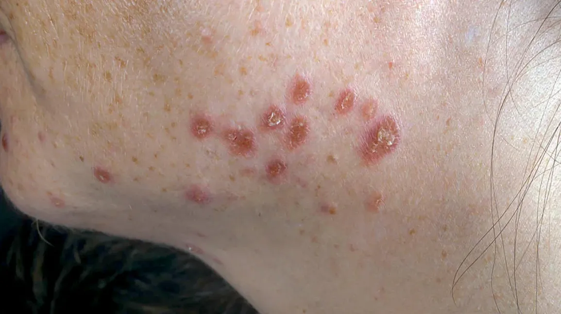 is sarcoidosis cancer