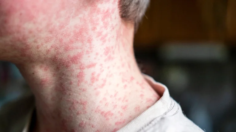 roseola vs measles rash.