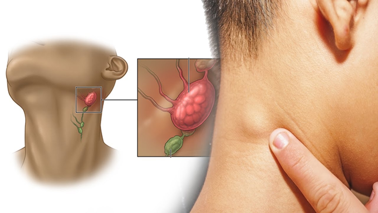 treat swollen lymph nodes in neck naturally