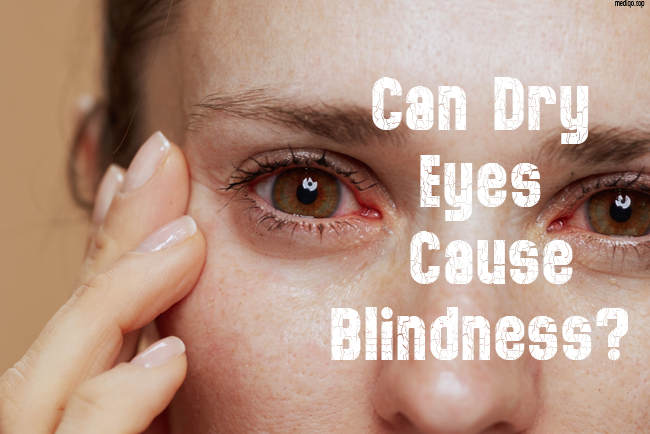 Can Dry Eyes Cause Blindness?