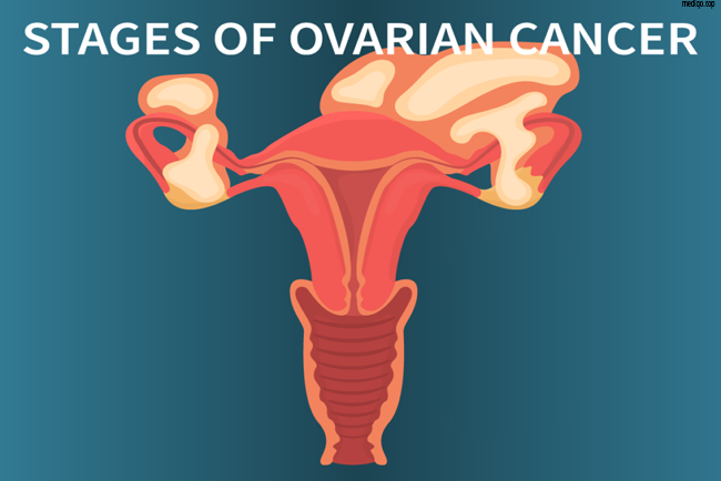 early stage ovarian cancer ultrasound