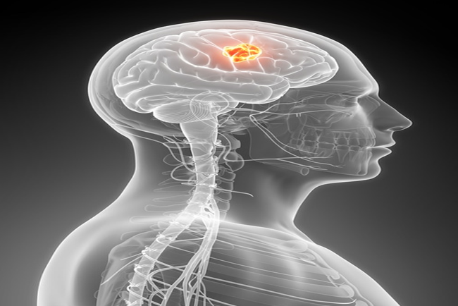 How to Detect Brain Tumor at Home
