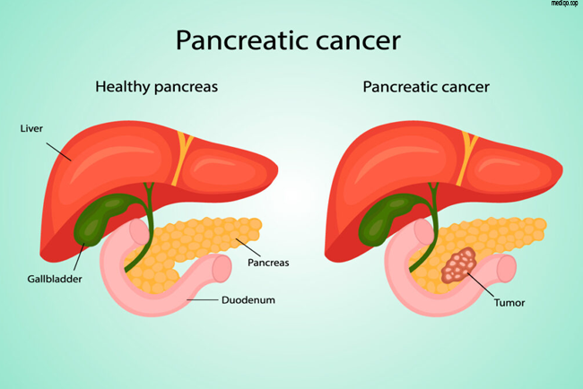 how to prevent pancreatic cancer