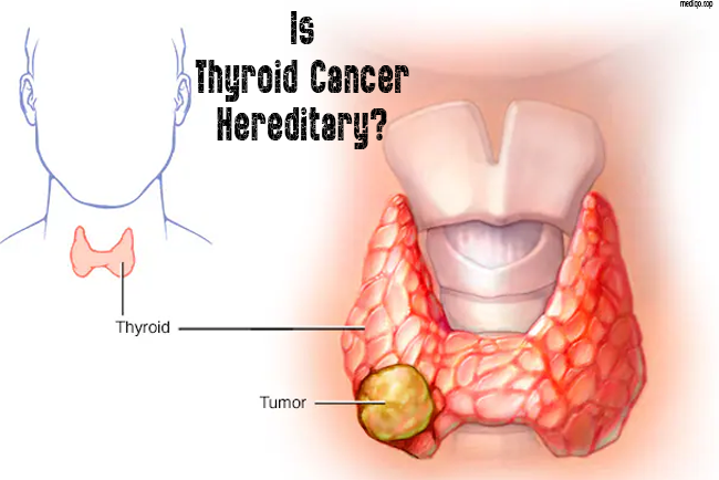 Is Thyroid Cancer Hereditary