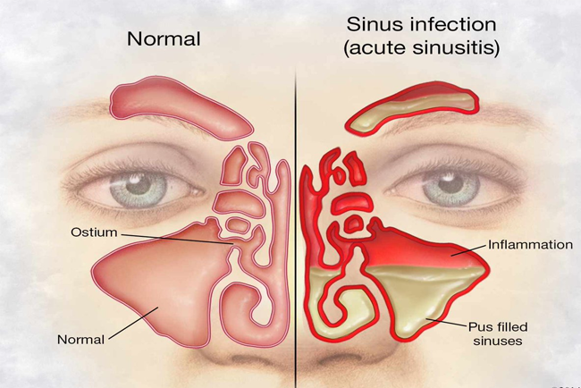 how to tell if sinus infection has spread to brain