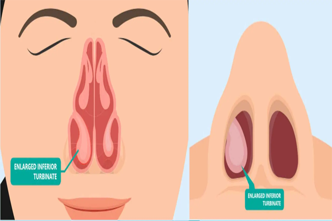 seasonal allergies icd 10