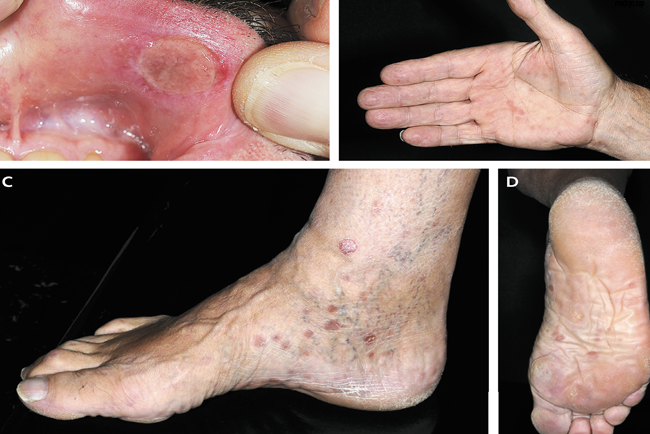 What Does Syphilis Look Like