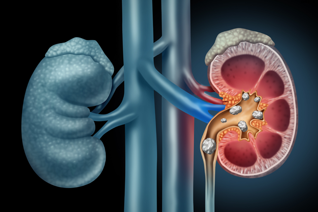 Are Kidney Stones Dangerous? Risks, Symptoms, and Prevention Guide