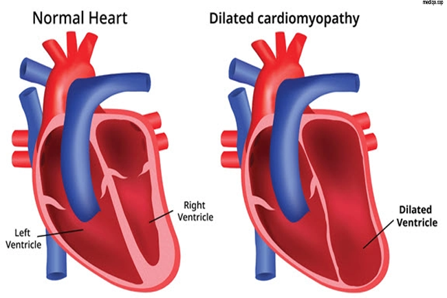 ICD 10 Coronary Artery Disease: Codes, Symptoms, Diagnosis and Treatment