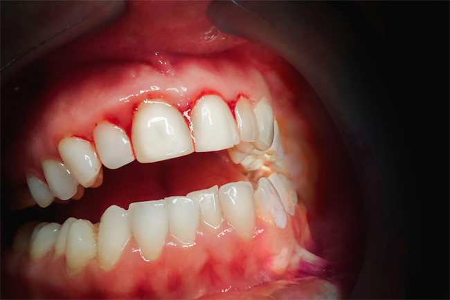 Is Gum Disease Contagious