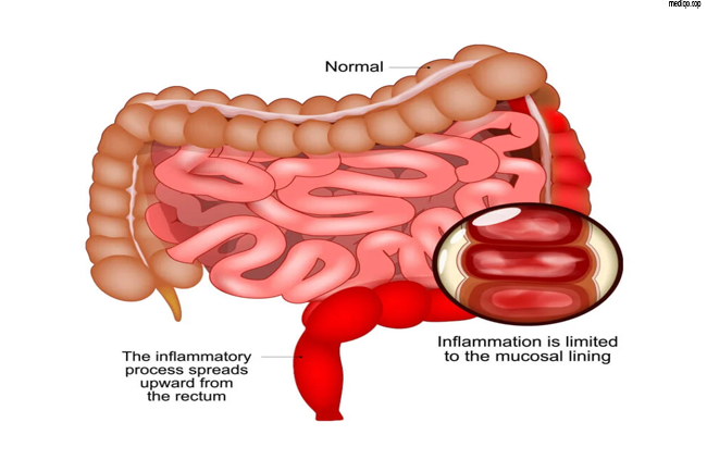 Is Ulcerative Colitis a Disability? Symptoms, Impacts, and Eligibility