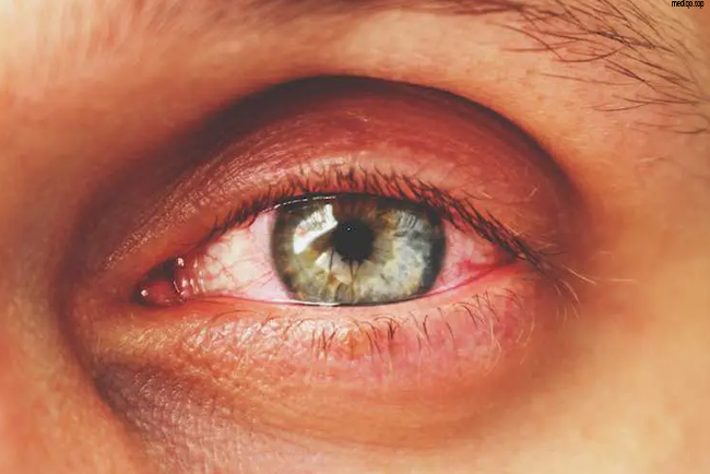 first signs of thyroid eye disease