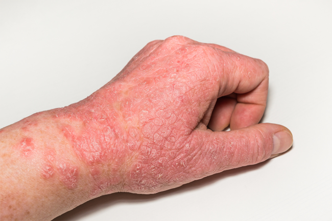 Is Eczema an Autoimmune Disease