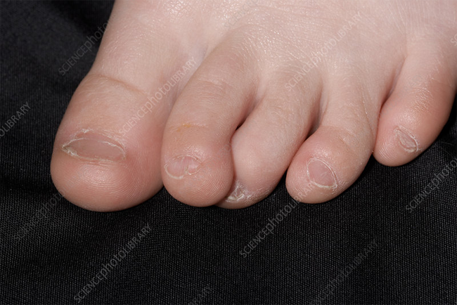 Overlapping Toes Genetic Disorder