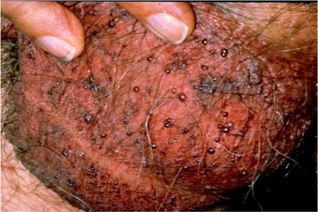 non infectious penile lesions