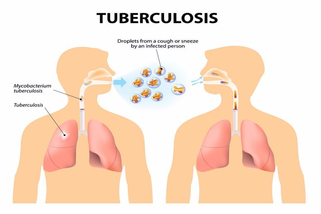 pulmonary tuberculosis