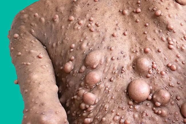 Neurofibromatosis