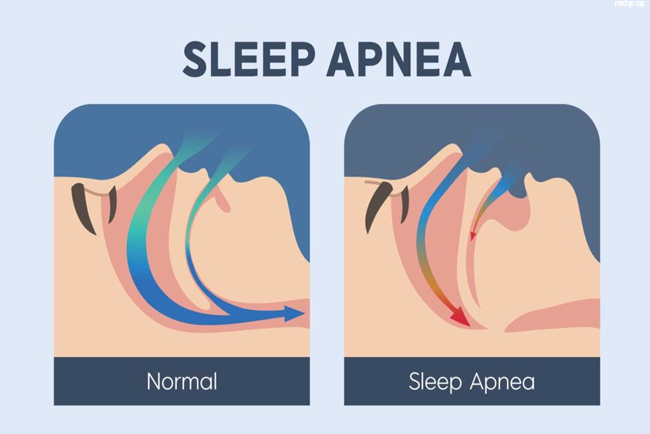 sleep apnea symptoms