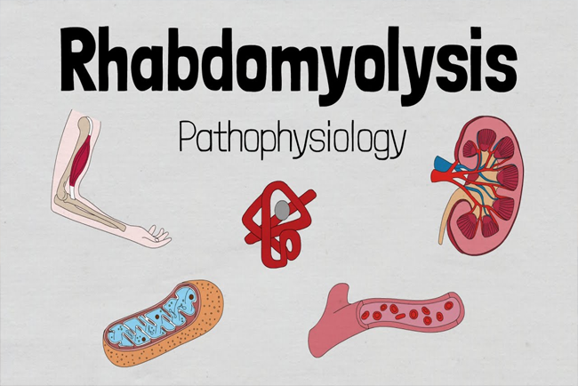 Rhabdomyolysis