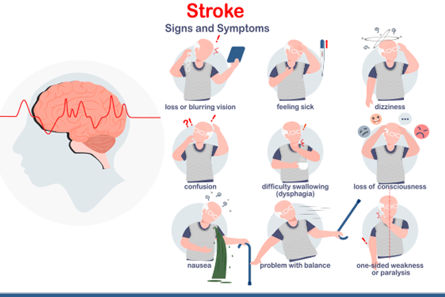 Stroke