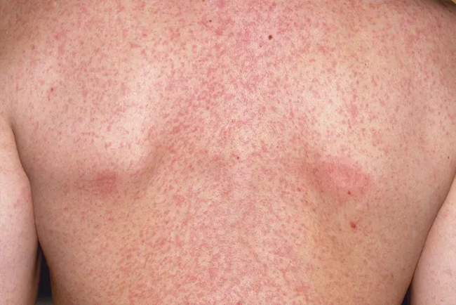 Rubella
